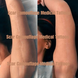 before and after pic arm lift scar is now seamlessly blended with the surrounding skin tha