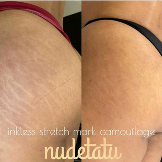 Effective scar removal and camouflage techniques  nudetatu redlands ca