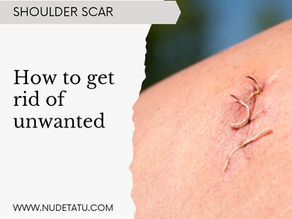 DO YOU HAVE A SHOULDER SURGERY YOU WANT TO GET RID OF?