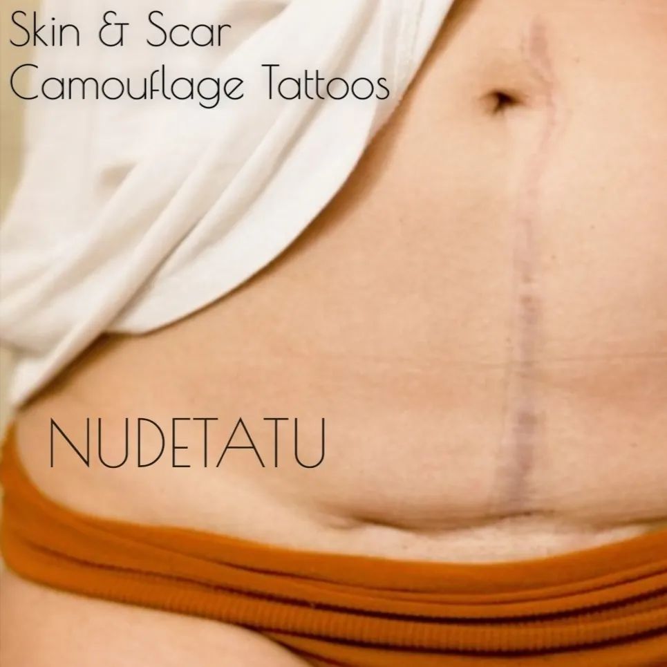 "NUDETATU: Transformative medical tattoos concealing cosmetic surgery scars." Redlands ca