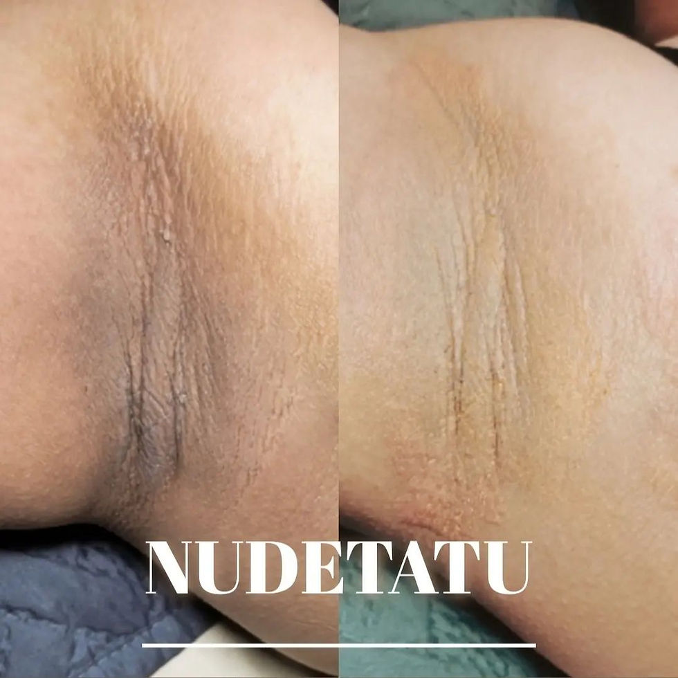 DARK UNDERARMS SKIN LIGHTENING NUDETATU REDLANDS CA