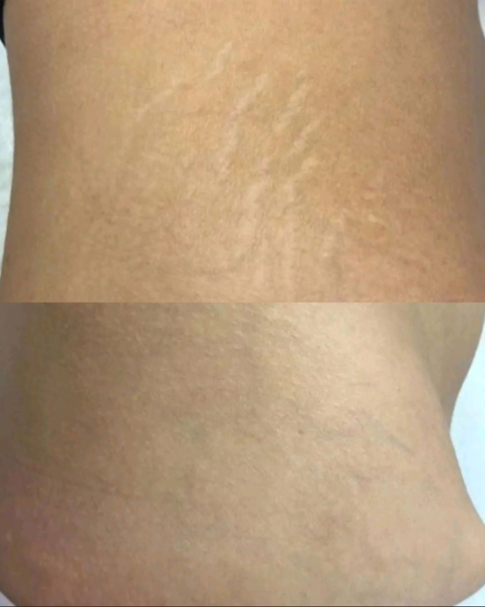 Close-up of skin with fading stretch marks; top shows more visible marks while bottom shows smoother, clearer skin. Neutral tone. SOUTHERN CALIFORNIA SCAR CAMOUFLAGE MEDICAL TATTOOS RANCHO CUCAMONGA CA