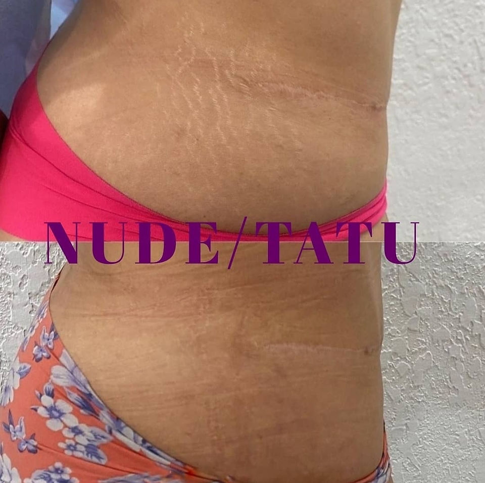 Hips and butt stretch mark removal beofre and after nudetatu redlands ca
