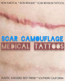 Redlands, CA medical tattoo studio specializing in scar camouflage for tummy tuck scars. Creating na