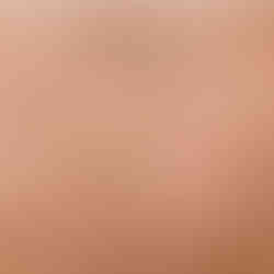 Does scar camouflage work before and after picture nudetatu redlands cs