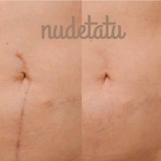Does scar camouflage work before and after picture nudetatu redlands cs