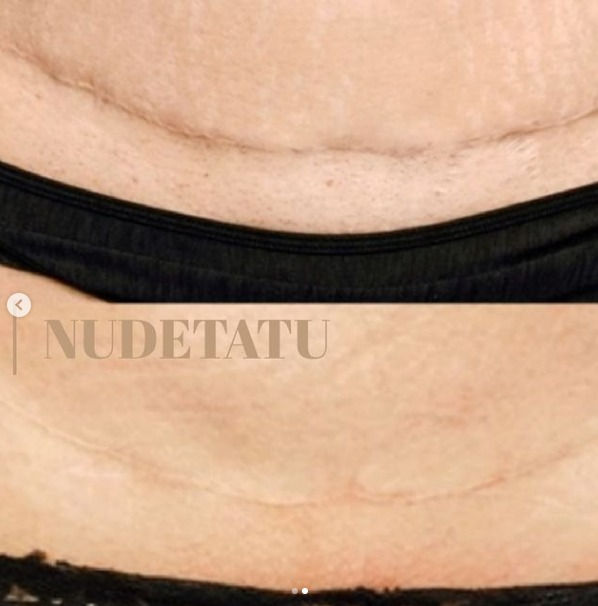 Scar Camouflage or Micro Pigmentation for Scars & Stretch Marks Scar & Stretch Mark Camouflage Medical Tattoos Scar Camouflage or Micro Pigmentation for Scars & Stretch Marks Scar & Stretch Mark Camouflage Medical Tattoos