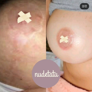 Areola reconstruction before and after 3d nipple nudetatu redlands ca 