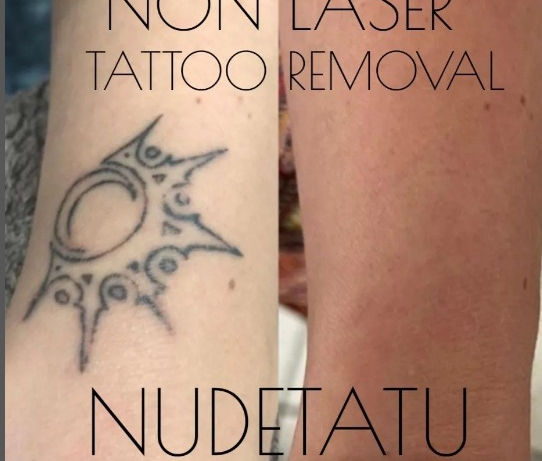 non-laser tattoo removal skin camouflage tattoo nudetatu redlands ca