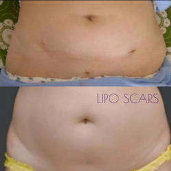 cosmetic surgery Before and after images showcasing scar camouflage tattoos for liposuction scars at