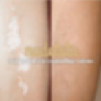 Lightening tattoo art gracefully blending with the skin, minimizing the appearance of scars for a personalized aesthetic nudetatu redlands ca