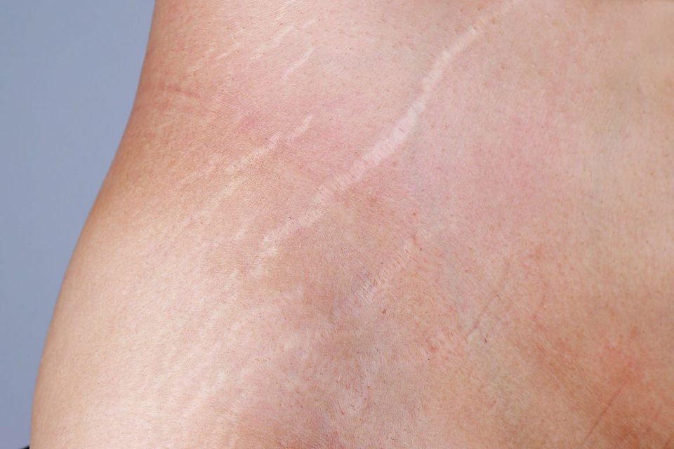 camouflage for white stretch marks nudetatu redlands ca