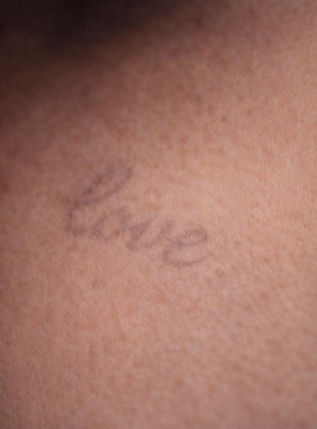 Softened tattoo appearance after camouflage treatment blending ink into natural skin tone