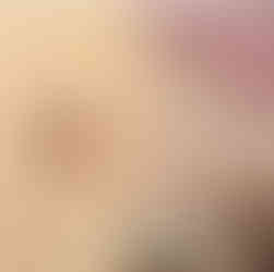 Liposuction dark belly button spots scar camouflage training nudetatu redlands ca