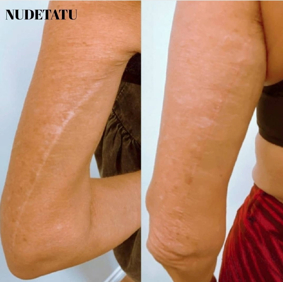 Accidental and surgical scar revision before and after nudetatu redlands ca