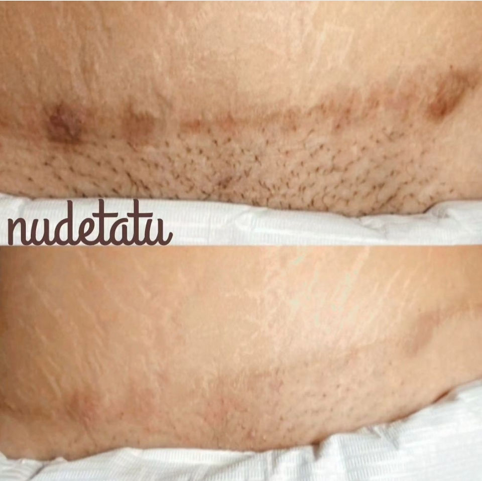 How to make my scar look less noticeable scar camouflage nudetatu redlands ca