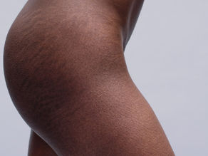 How Much Does Scar & Stretch Mark Camouflage Cost