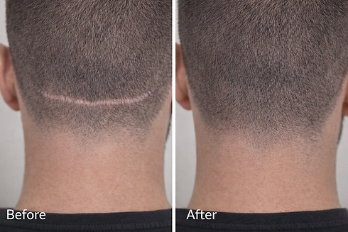 NUDETATU Redlands CA scalp micropigmentation before and after showing hair transplant scar