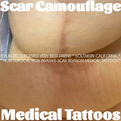 cosmetic surgery anchor scars Before and after images showcasing the transformative effect