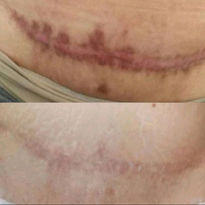 Dramatic improvement in scar appearance using camouflage tattooing. Before and after.
scar camouflage medical tattoos Rancho Cucamonga ca