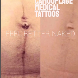 southern california scar camouflage medical tattoos for c-section scar rancho cucamonga irvine california