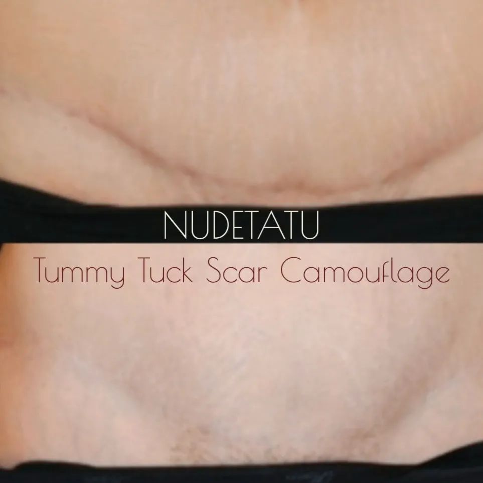 Tummy tuckcscar camouflage nudetatu redlands ca 