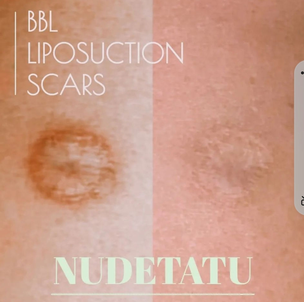Before and after of expertly applied lipo scar camouflage, showcasing the seamless integration with the surrounding skin for natural and discreet coverage nudetatu redlands ca