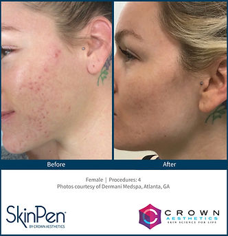 BA acne scars 4.jpg