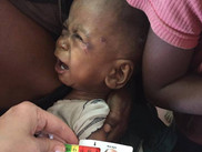 desnutrição-grave-em-madagascar-fsf-ajud