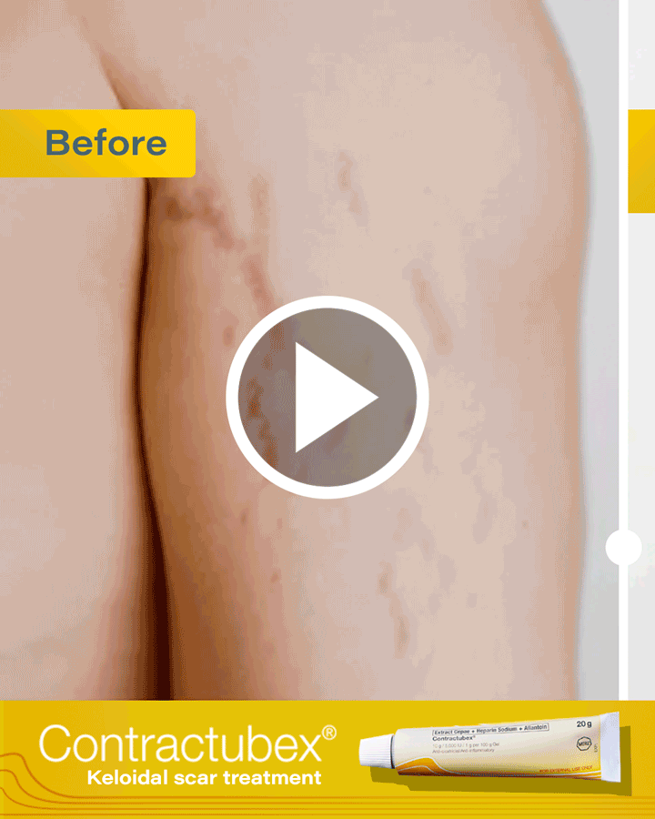 Contractubex---Video---Slider-X.gif
