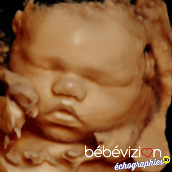 Bébévizion échographie 3D 4D 5D ultrasound 25