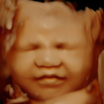 Échographie 3D 4D 5D bébé visage souriant gros plan Montréal Bébévizion / 3D 4D 5D baby smiling face close-up ultrasound Montreal Bébévizion