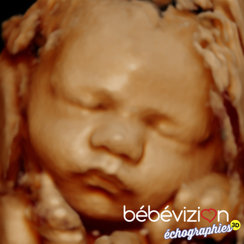 Bébévizion échographie 3D 4D 5D ultrasound 3