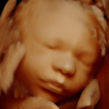 Échographie 3D 4D 5D bébé visage souriant Montréal Bébévizion / 3D 4D 5D baby smiling face ultrasound Montreal Bébévizion