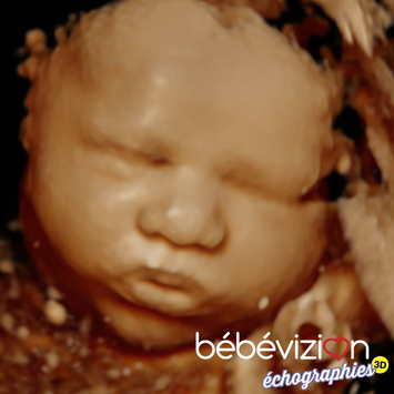 Bébévizion échographie 3D 4D 5D ultrasound 24