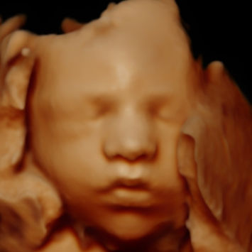 Échographie 3D 4D 5D bébé gros plan yeux et sourire Montréal Bébévizion / 3D 4D 5D baby close-up eyes and smile ultrasound Montreal Bébévizion