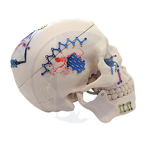 Titanium-Neuro-Fixation-Craniomaxilofaci