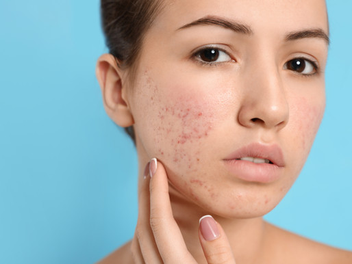 8 Top Tips For Acne Sufferers