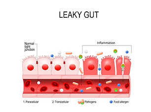 Leaky gut diagram