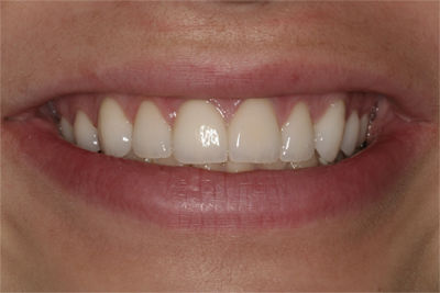 Patient 2 After