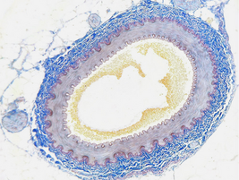 동맥경화: 위험한 플라크를 제거하는 새로운 항체 치료법