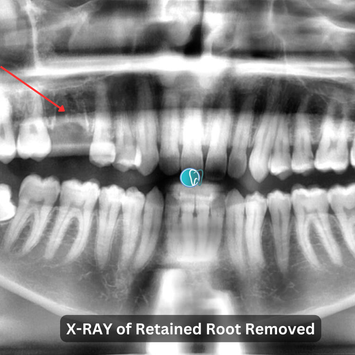 X-RAY of Retained Root Removed
