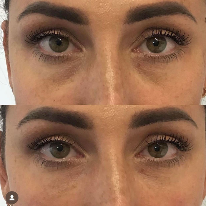 front angle of dermal filler before and after results provided at our aesthetics clinic based in Chester.