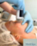 dermaforce rf microneedling results Chester