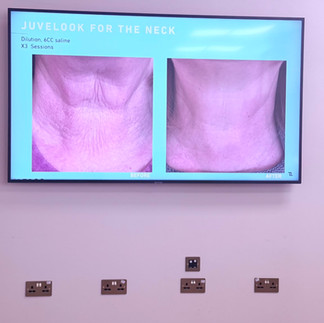 Juvelook and lenisna before and after results
