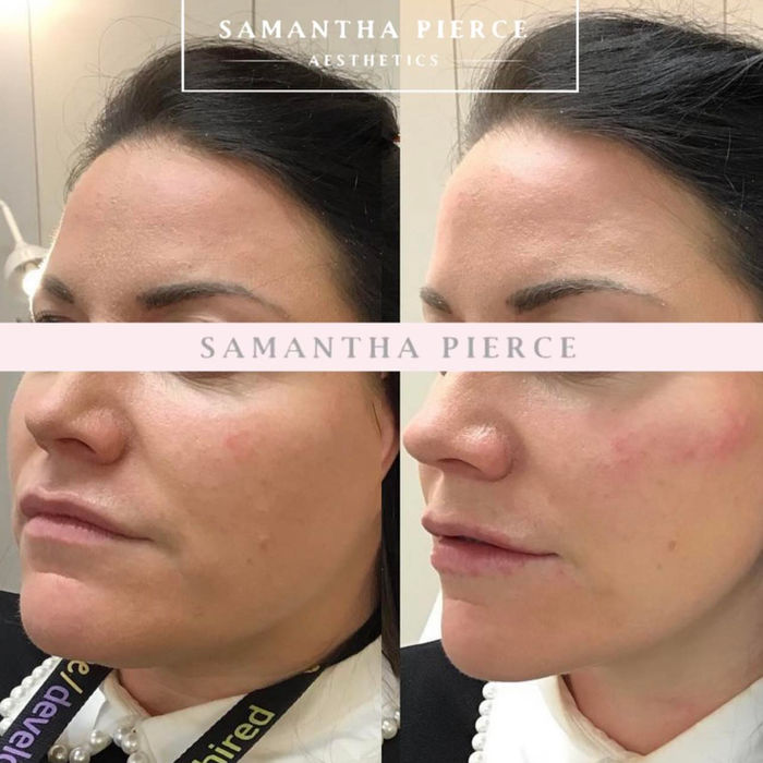front angle of dermal filler before and after results provided at our aesthetics clinic based in Chester.