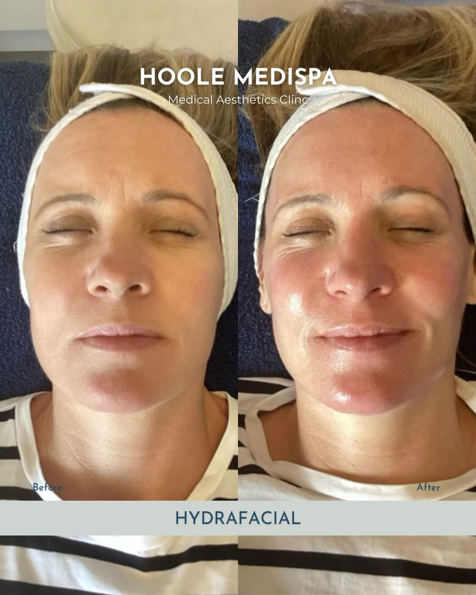 An above angle of Hydrafacial Chester before and after results