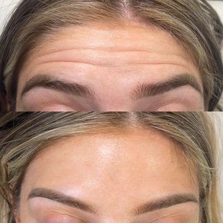before and after results for upper face anti-wrinkle injections in Portsmouth