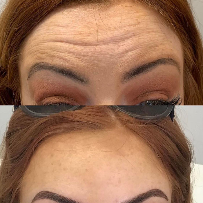front angle of before and after results of anti-wrinkle injections provided by Samantha Pierce Aesthetics based in Chester.