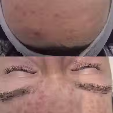 acne forehead results